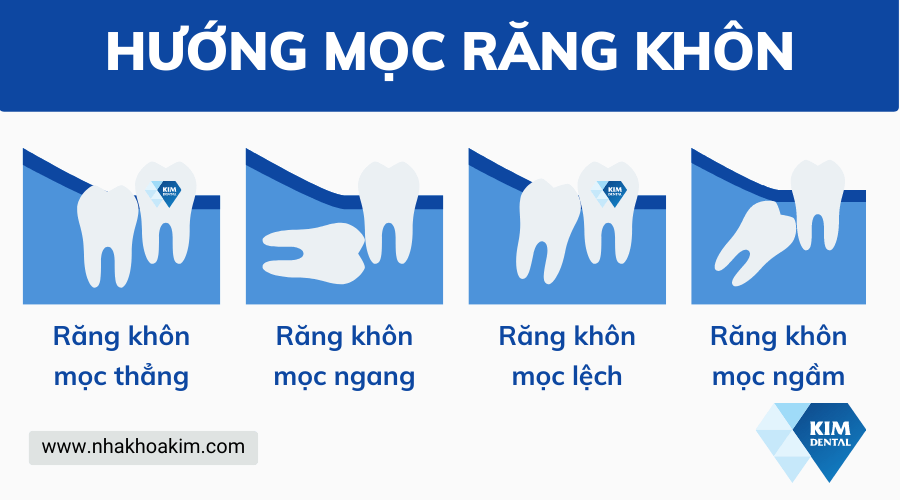 Hướng mọc của răng khôn