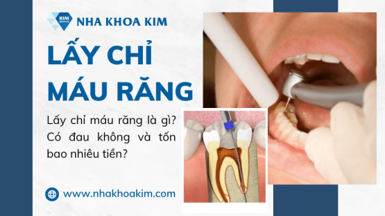 Lấy chỉ máu răng là gì? Có đau không và tốn bao nhiêu tiền?