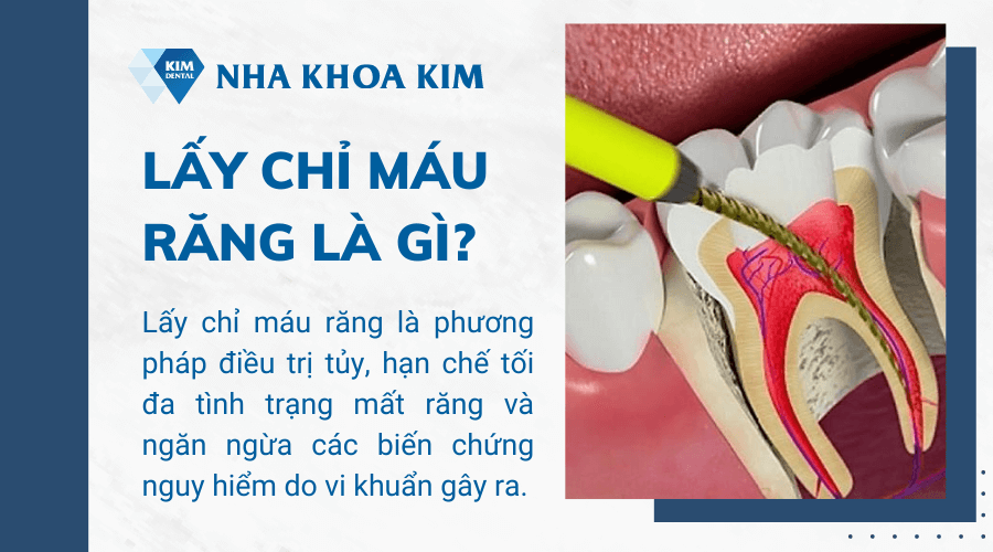 Lấy chỉ máu răng là gì?