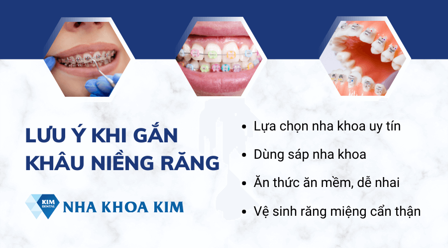 Một số lưu ý khi gắn band niềng răng