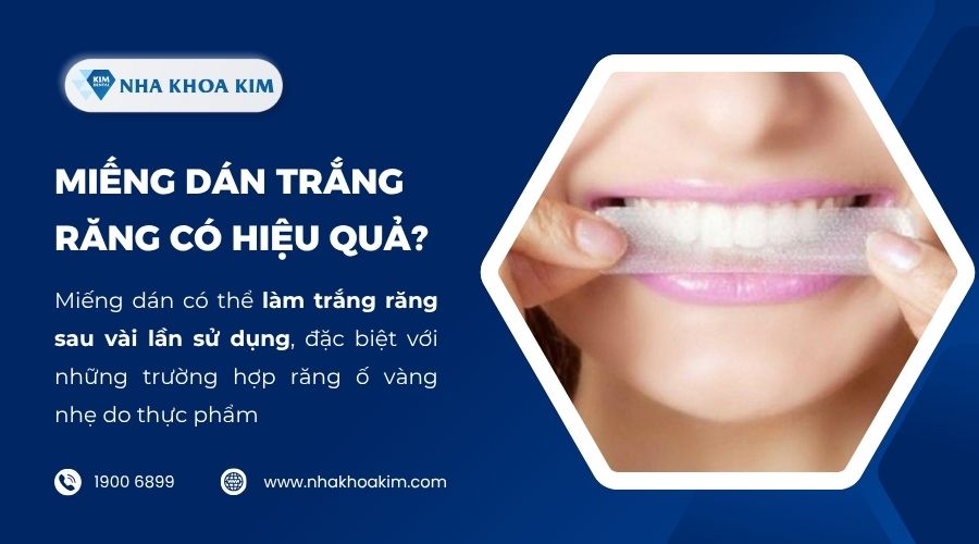 Miếng dán trắng răng có hiệu quả không?