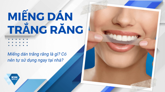 Miếng dán trắng răng là gì? Có nên tự sử dụng ngay tại nhà?