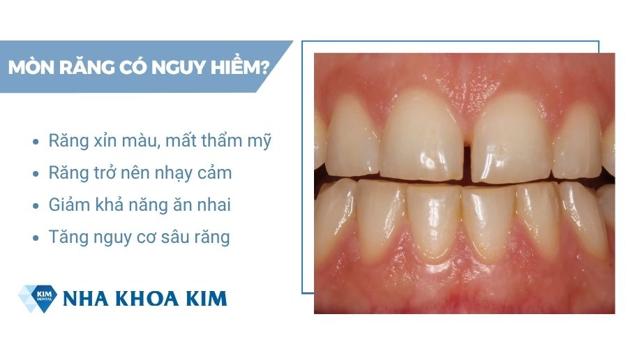 hậu quả của răng bị mòn