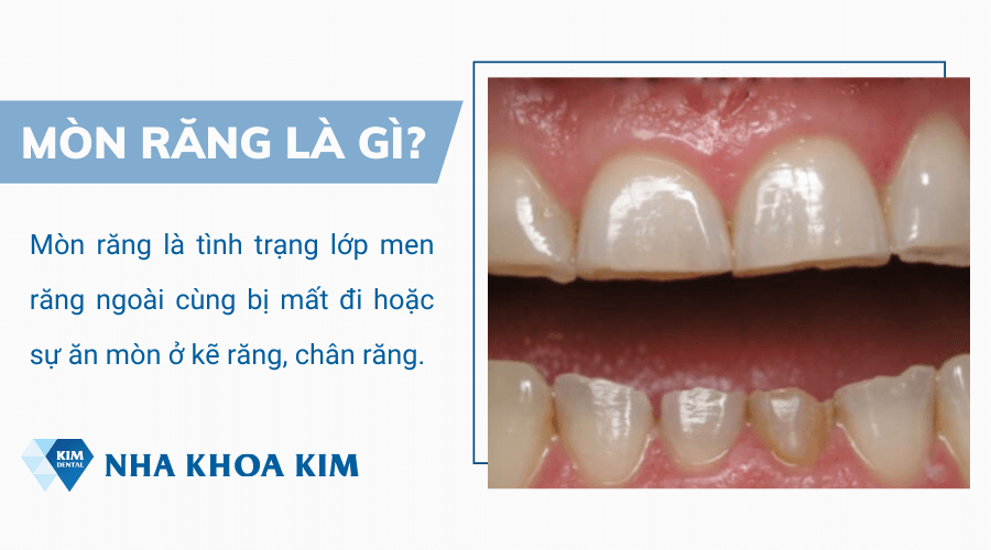 Hiện tượng mòn răng là gì?