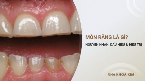 Mòn răng là gì? Nguyên nhân, dấu hiệu và cách điều trị