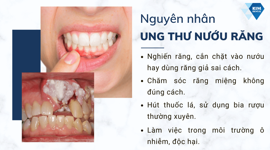 Nguyên nhân gây ung thư nướu răng