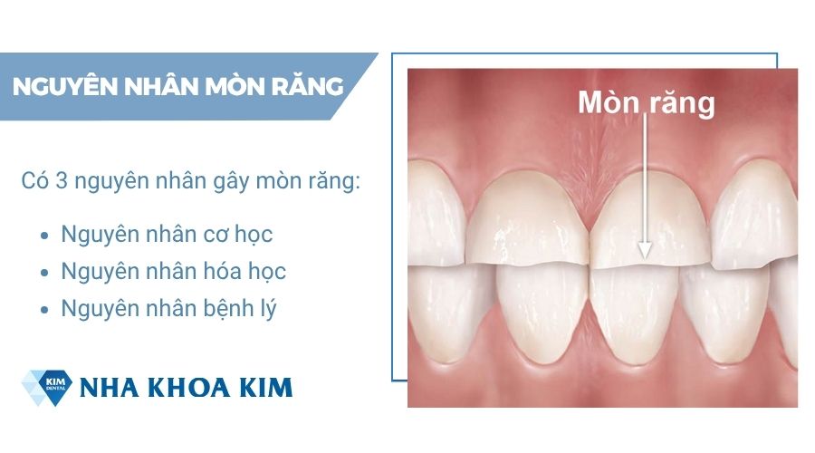 tại sao bị mòn men răng