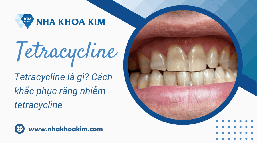 Bạn có răng nhiễm tetracycline ? Tìm hiểu nguyên nhân và cách giải quyết