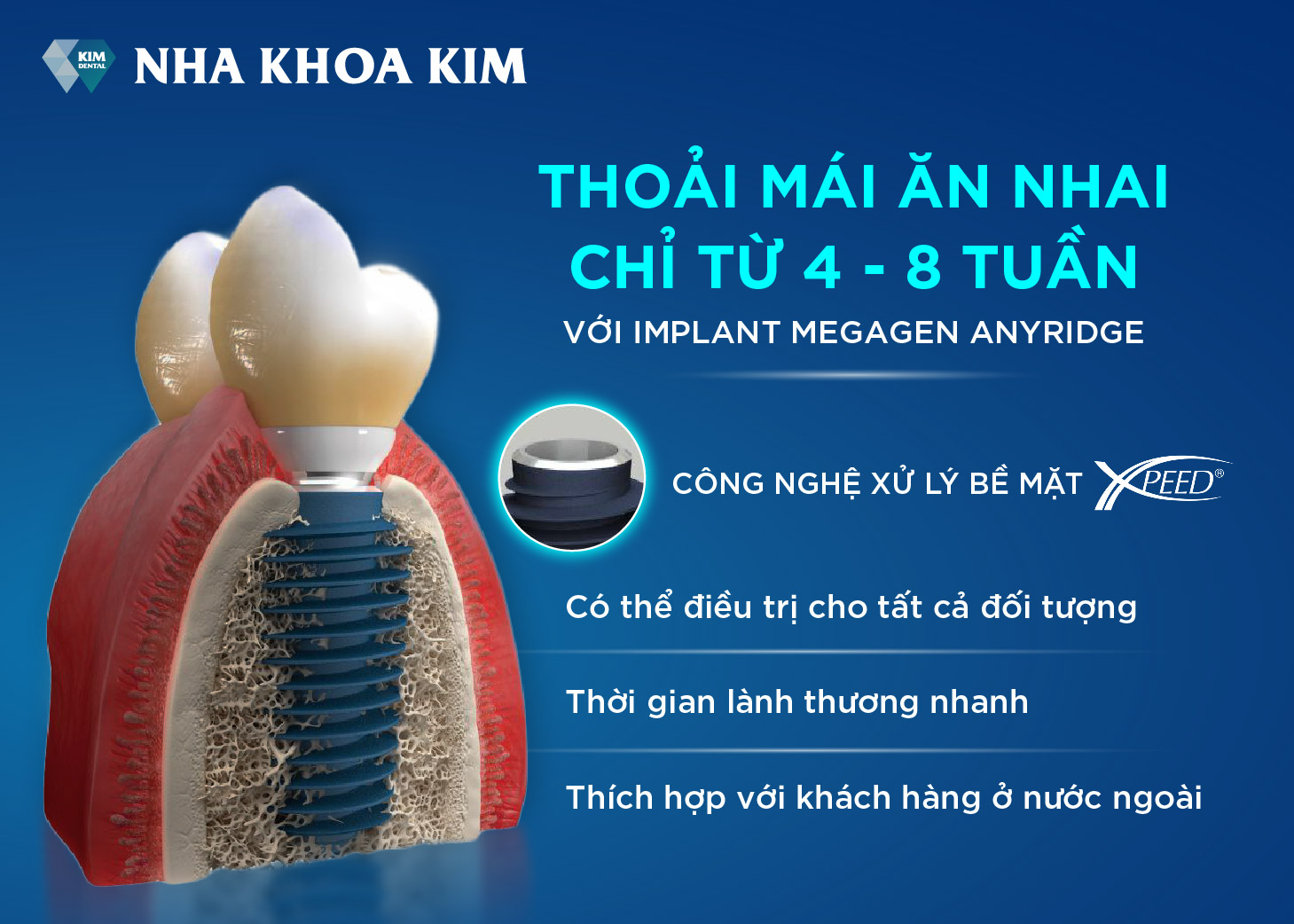 trồng răng implant - trụ implant megagen anyridge