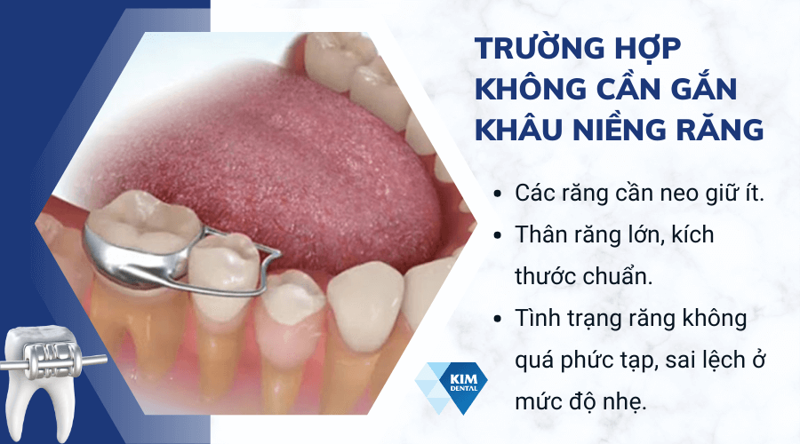 Trường hợp không cần gắn band niềng răng