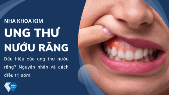 Dấu hiệu ung thư nướu răng? Nguyên nhân và cách điều trị sớm