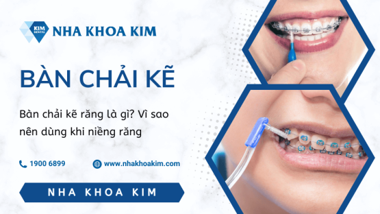 Bàn chải kẽ răng là gì? Vì sao nên dùng khi niềng răng