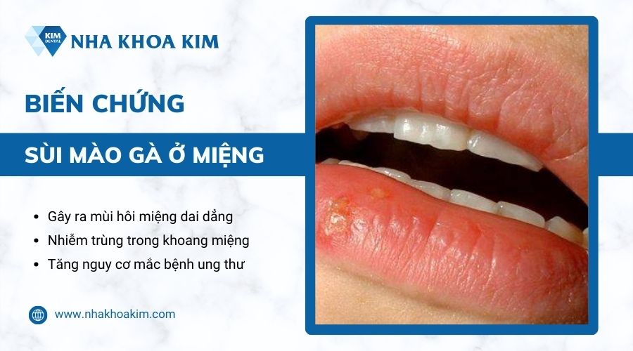 bệnh sùi mào gà ở miệng có nguy hiểm không?