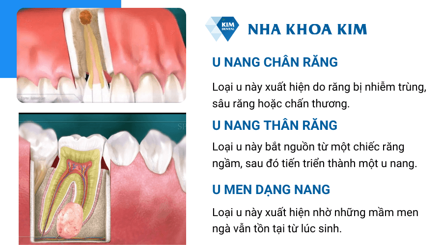 Các loại u răng 