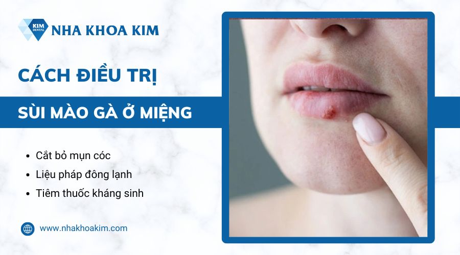 cách chữa sùi mào gà ở miệng