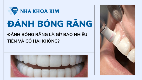 Đánh bóng răng là gì? Bao nhiêu tiền và có hại không?