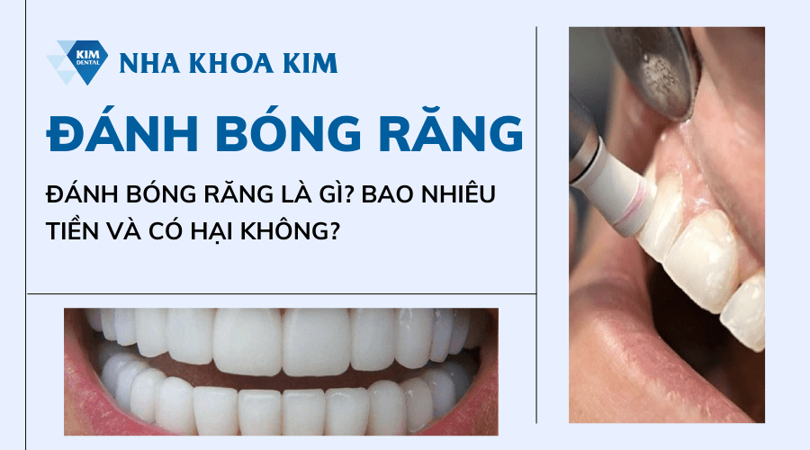 Đánh bóng răng là gì? Bao nhiêu tiền và có hại không?