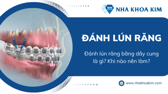 Đánh lún răng bằng dây cung là gì? Khi nào nên làm?