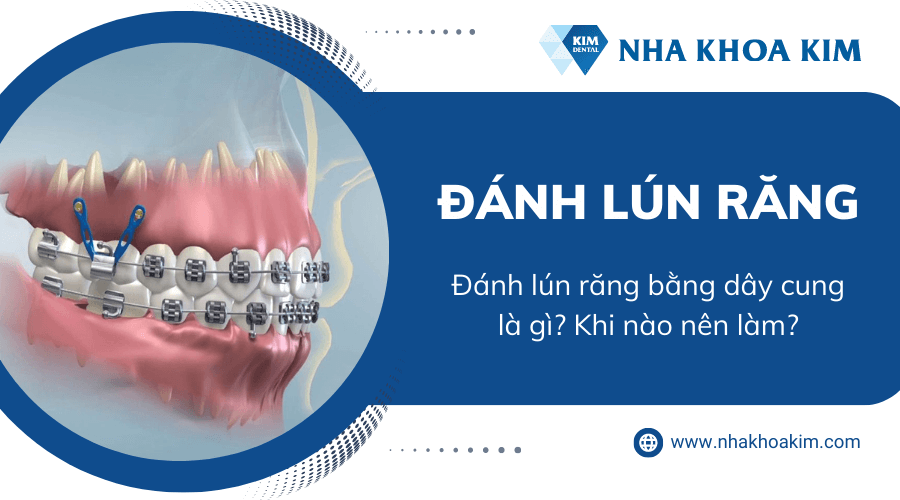 Đánh lún răng bằng dây cung là gì? Khi nào nên làm?