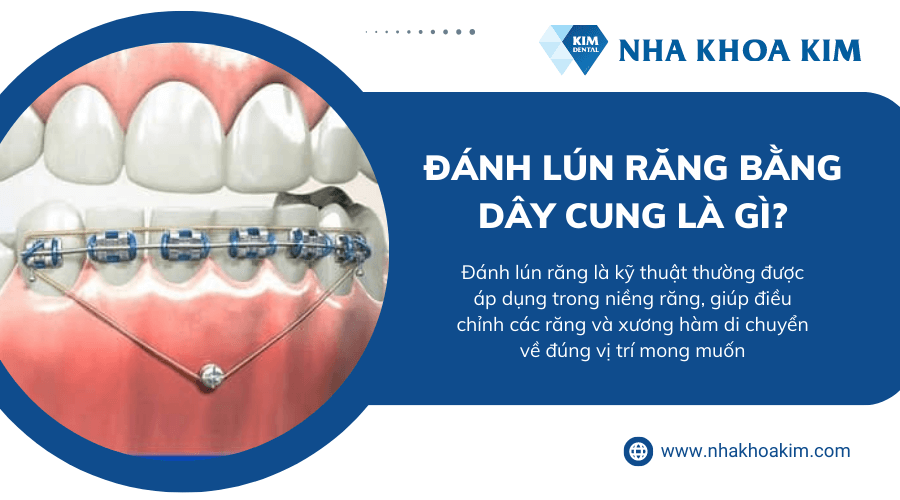 Đánh lún răng bằng dây cung là gì?