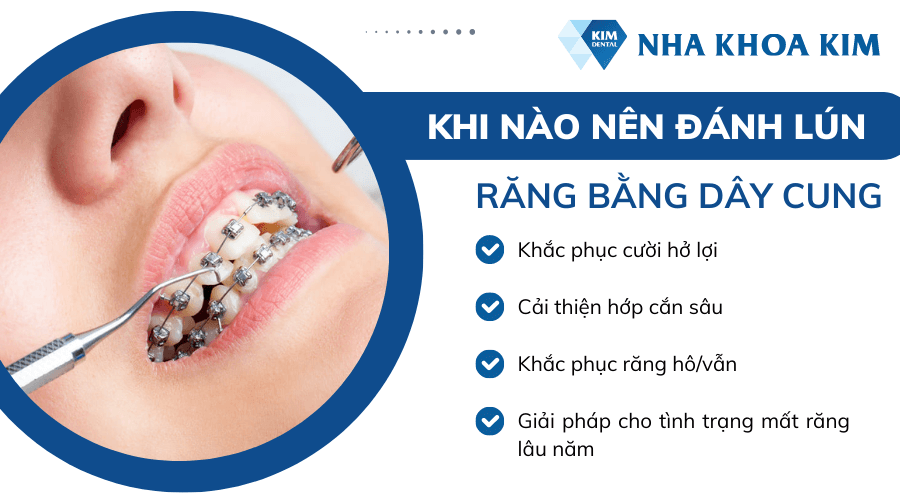 Khi nào nên đánh lún răng bằng dây cung?