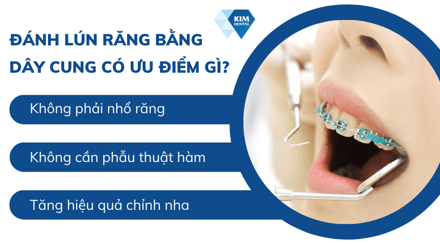 Đánh lún răng bằng dây cung có ưu điểm gì?