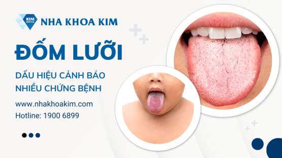 Hiện tượng đốm lưỡi: dấu hiệu cảnh báo nhiều chứng bệnh