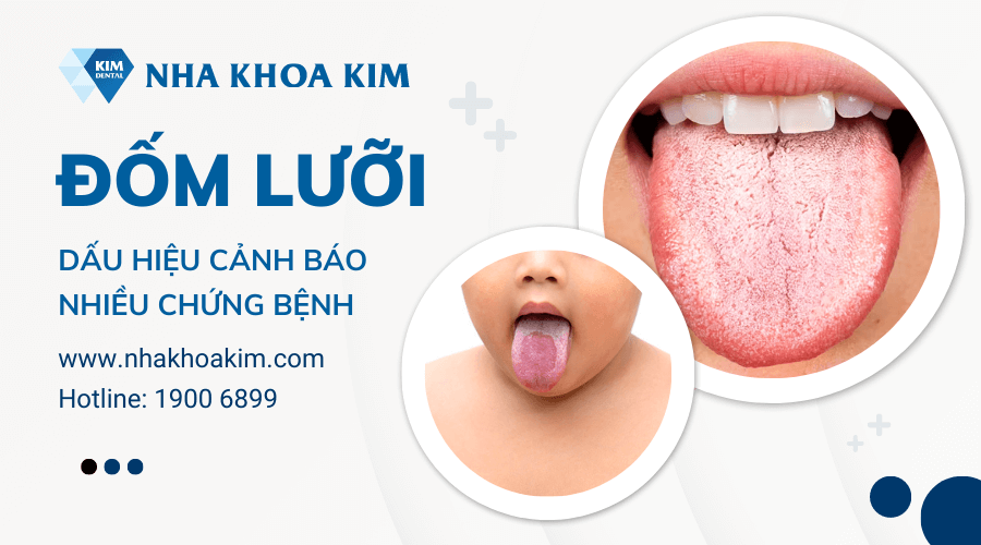 Hiện tượng đốm lưỡi: dấu hiệu cảnh báo nhiều chứng bệnh