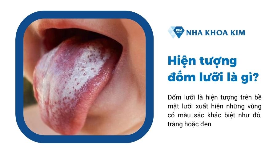 Đốm lưỡi là gì