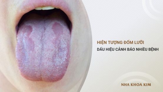 Hiện tượng đốm lưỡi: dấu hiệu cảnh báo nhiều chứng bệnh