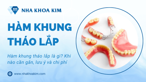 Hàm khung tháo lắp là gì? Khi nào cần gắn, lưu ý và chi phí