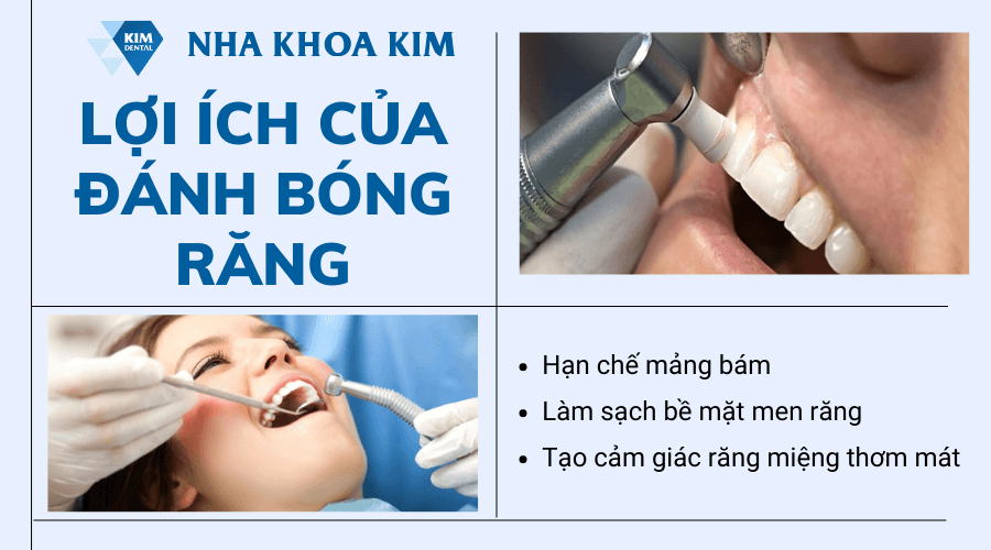 Lợi ích của đánh bóng răng 