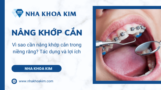 Vì sao cần nâng khớp cắn trong niềng răng? Tác dụng và lợi ích