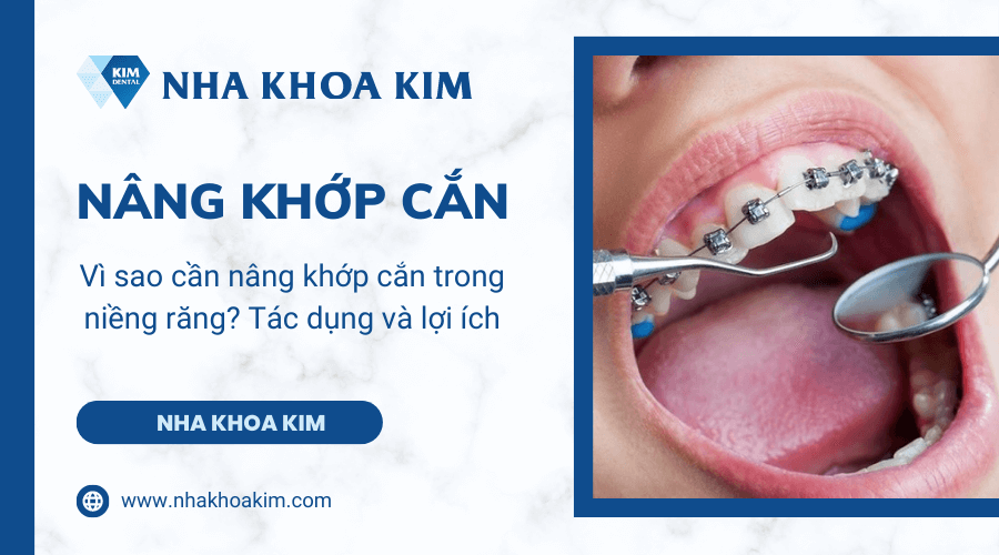 Vì sao cần nâng khớp cắn trong niềng răng? Tác dụng và lợi ích