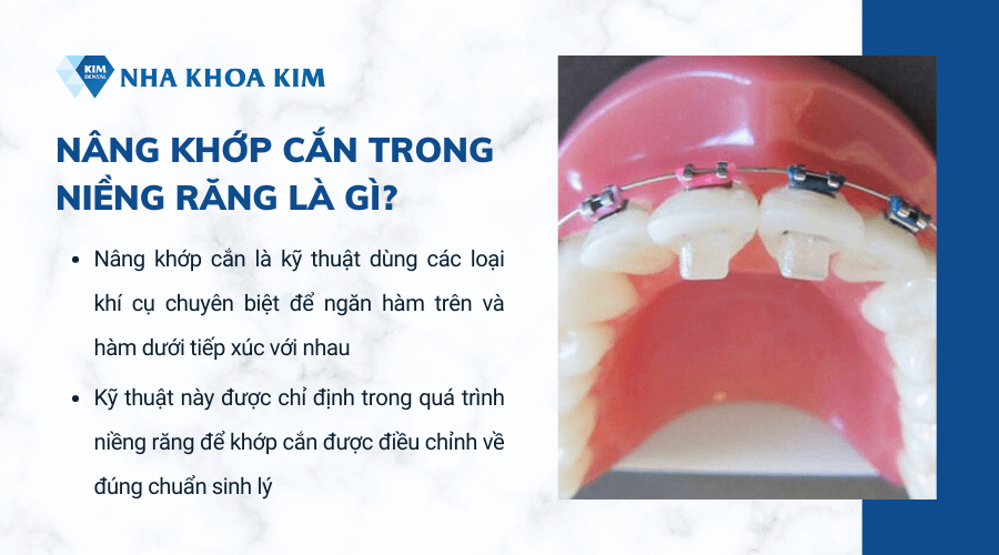 Nâng khớp cắn trong niềng răng là gì?