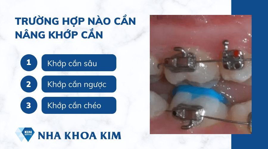 Trường hợp nào cần nâng khớp cắn?