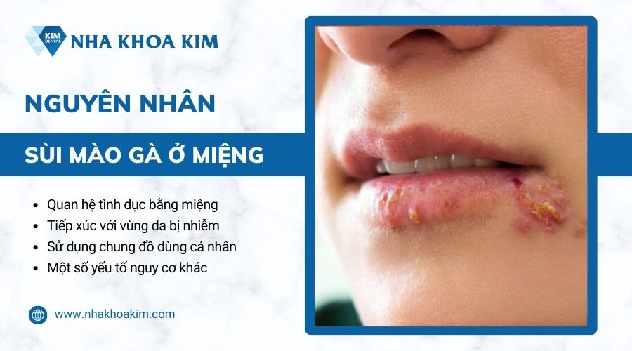 nguyên nhân sùi mào gà ở miệng