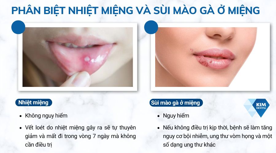 phân biệt nhiệt miệng và sùi mào gà ở miệng