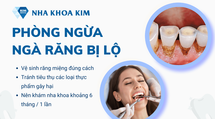 Phòng ngừa ngà răng bị lộ