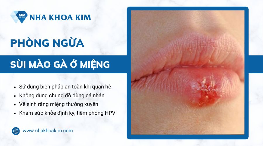 phòng ngừa bệnh sùi mào gà mọc ở miệng