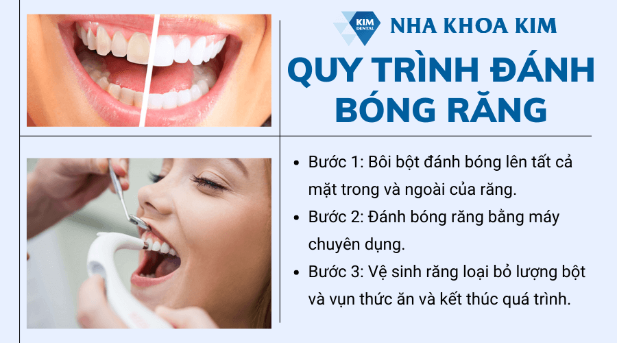 Quy trình đánh bóng răng tiêu chuẩn 