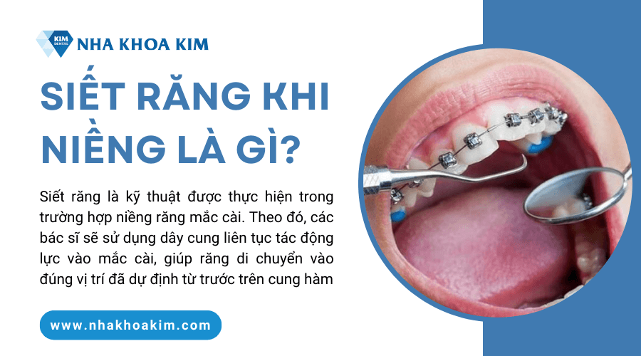 Siết răng khi niềng là gì?