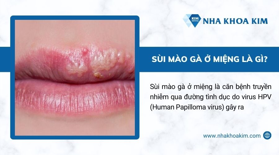 sùi mào gà ở miệng là gì?