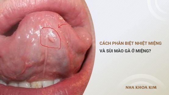 Cách phân biệt nhiệt miệng và sùi mào gà ở miệng?