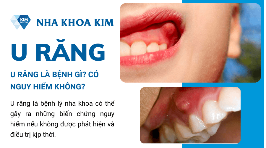 U răng là bệnh gì? Có nguy hiểm không?