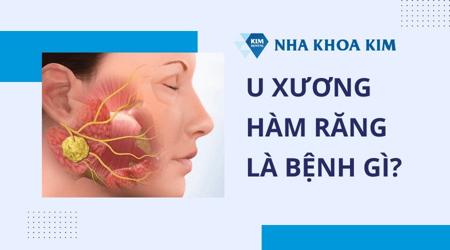 U xương hàm răng: Nguyên nhân và cách điều trị