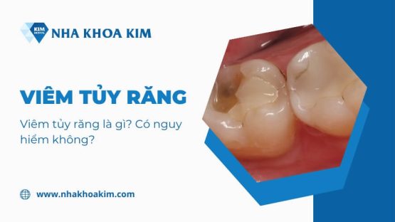 Viêm tủy răng: Dấu hiệu, nguyên nhân và cách điều trị