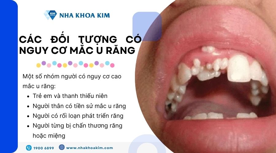 Các đối tượng có nguy cơ mắc u răng