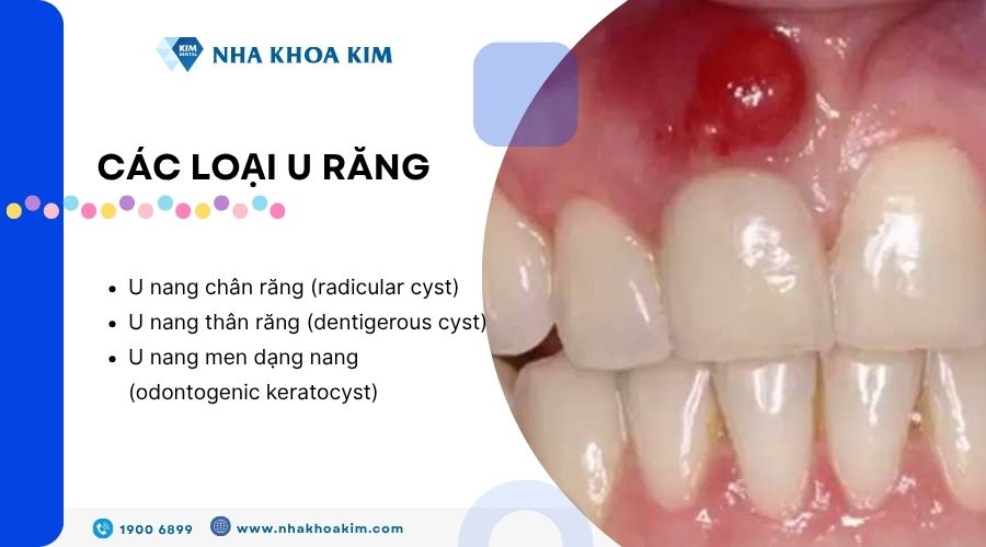 Các loại u răng
