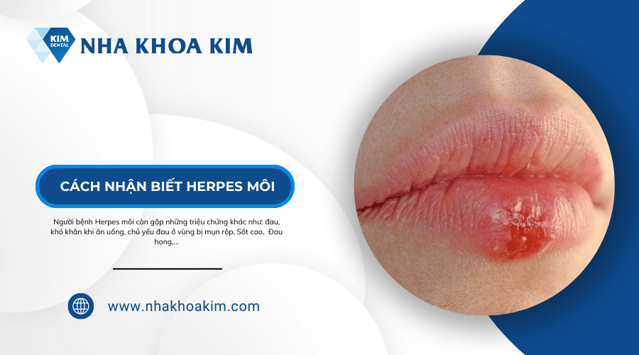 Cách nhận biết Herpes môi